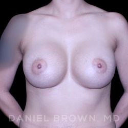 Breast Augmentation Before & After Patient #9284