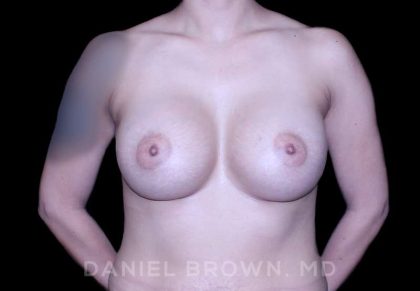 Breast Augmentation Before & After Patient #9284