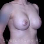 Breast Augmentation Before & After Patient #9284