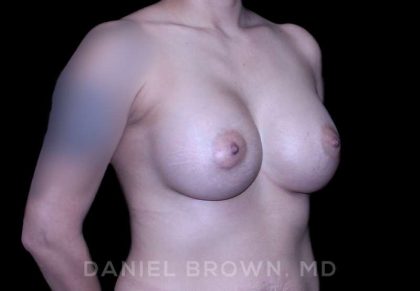 Breast Augmentation Before & After Patient #9284