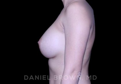 Breast Augmentation Before & After Patient #9284