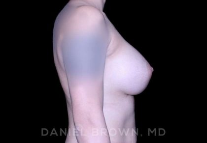 Breast Augmentation Before & After Patient #9284