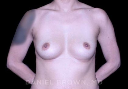Breast Augmentation Before & After Patient #9284