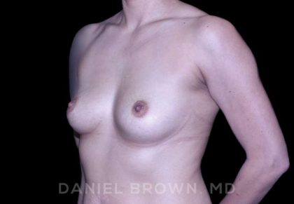 Breast Augmentation Before & After Patient #9284