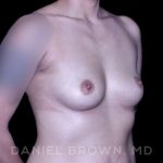 Breast Augmentation Before & After Patient #9284