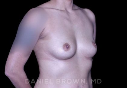 Breast Augmentation Before & After Patient #9284
