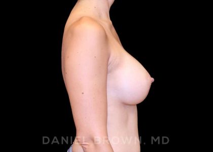 Breast Augmentation Before & After Patient #9295