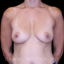 Breast Augmentation Before & After Patient #9295