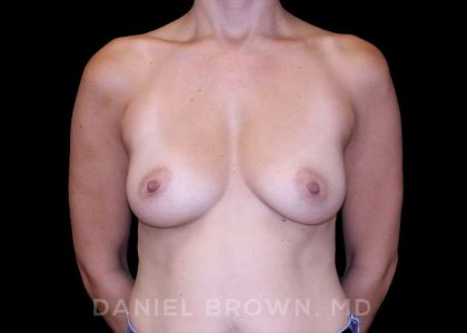Breast Augmentation Before & After Patient #9295