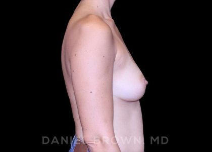 Breast Augmentation Before & After Patient #9295