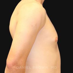 Gynecomastia Before & After Patient #9986