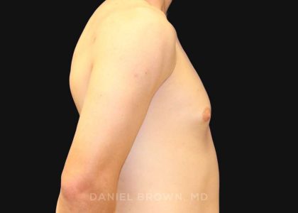 Gynecomastia Before & After Patient #9986