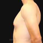 Gynecomastia Before & After Patient #9986