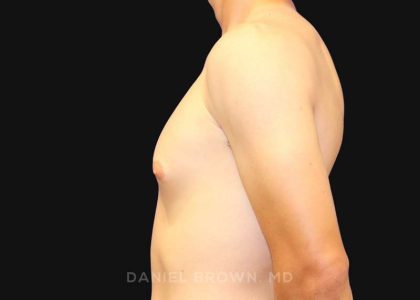 Gynecomastia Before & After Patient #9986