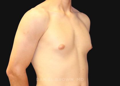 Gynecomastia Before & After Patient #9986