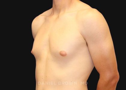 Gynecomastia Before & After Patient #9986