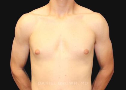 Gynecomastia Before & After Patient #9986