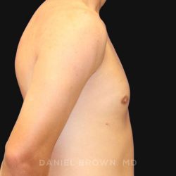 Gynecomastia Before & After Patient #9986