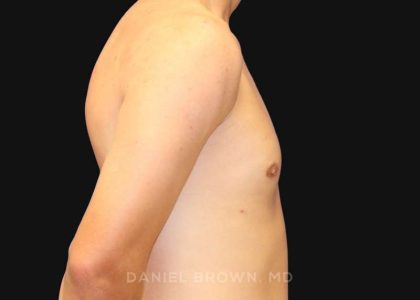 Gynecomastia Before & After Patient #9986