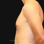Gynecomastia Before & After Patient #9986