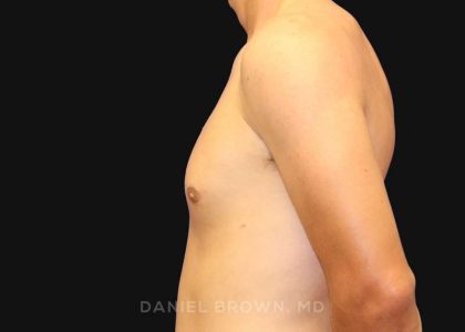 Gynecomastia Before & After Patient #9986