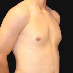 Gynecomastia Before & After Patient #9986