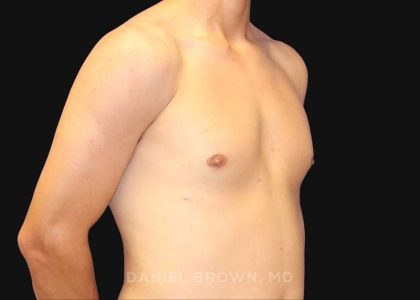 Gynecomastia Before & After Patient #9986