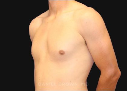 Gynecomastia Before & After Patient #9986