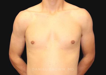 Gynecomastia Before & After Patient #9986