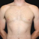 Gynecomastia Before & After Patient #9993
