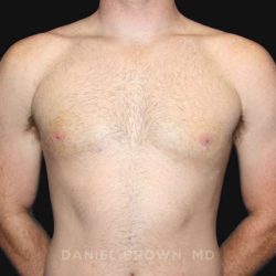 Gynecomastia Before & After Patient #9993