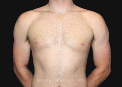 Gynecomastia Before & After Patient #9993