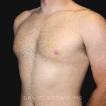Gynecomastia Before & After Patient #9993