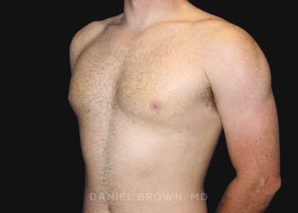 Gynecomastia Before & After Patient #9993