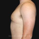 Gynecomastia Before & After Patient #9993