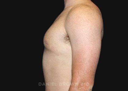 Gynecomastia Before & After Patient #9993