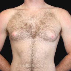 Gynecomastia Before & After Patient #9993