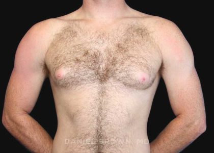 Gynecomastia Before & After Patient #9993