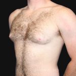 Gynecomastia Before & After Patient #9993