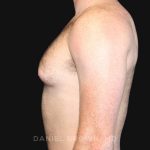 Gynecomastia Before & After Patient #9993