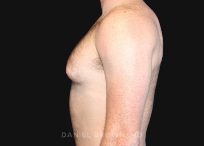 Gynecomastia Before & After Patient #9993