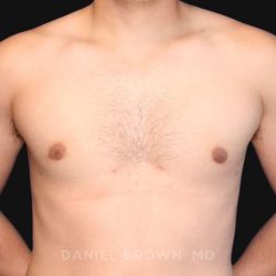 Gynecomastia Before & After Patient #10000