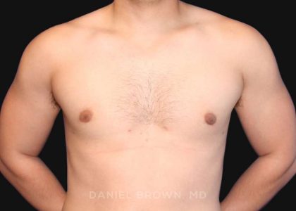 Gynecomastia Before & After Patient #10000