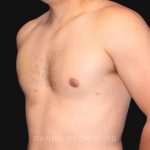 Gynecomastia Before & After Patient #10000