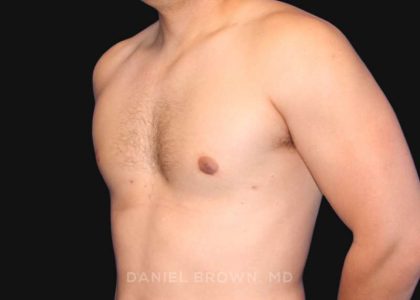 Gynecomastia Before & After Patient #10000
