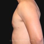 Gynecomastia Before & After Patient #10000