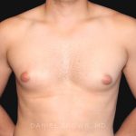Gynecomastia Before & After Patient #10000