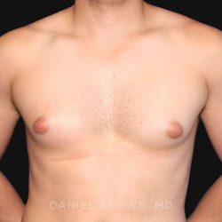 Gynecomastia Before & After Patient #10000