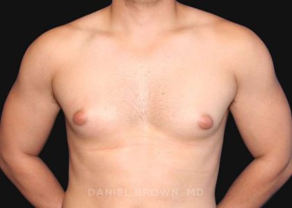 Gynecomastia Before & After Patient #10000