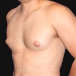Gynecomastia Before & After Patient #10000